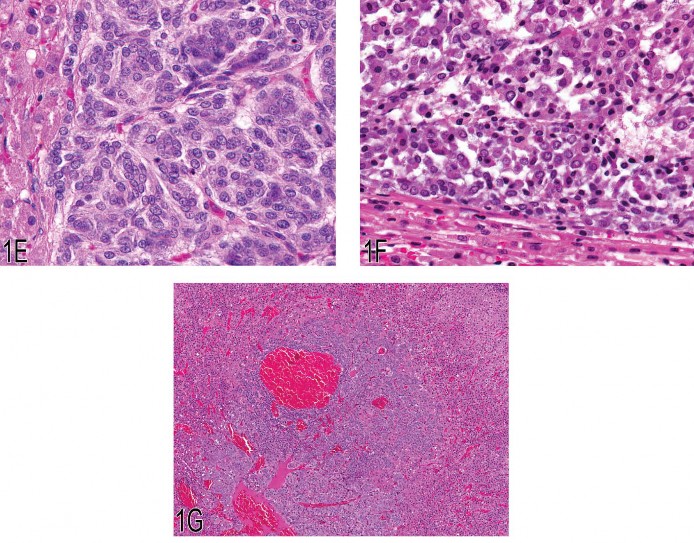 Fig 1. (A) Malignant pheochromocytoma with neoplastic cells in the periadrenal vasculature. (B) Pleomorphic neoplastic cells from the malignant pheochromocytoma shown in (A). (C) Neoplastic cells in the lumen of a periadrenal blood vessel from the malignant pheochromocy-toma shown in (A). (D) Compressive adrenal medullary mass with necrosis. (E) Cellular features of an adrenal medullary neuroblastoma. Note the closely packed neoplastic neuroblasts with scant cytoplasm. (F) Cellular features of the malignant pheochromocytoma shown in (D). Note the sheet of neoplastic chromaffin cells with abundant cytoplasm. (G) Focal hyperplasia of the adrenal medulla.