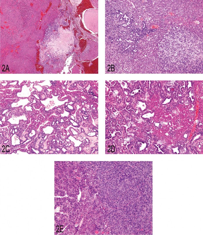 Fig 2. (A) Primary liver neoplasm demonstrating the classic presentation of a hepatocholangiocarcinoma (HCCC) as seen in the B6C3F1 mouse. There is an area of malignant hepatocellular proliferation (arrow) and areas of malignant ductal cell proliferation (arrowhead) adjacent to an area of necrosis and near an area of a cystlike formation (asterisk). (B) A portion of a primary HCCC demonstrating an area of malignant duct proliferation (arrow) and a focus of undifferentiated malignant cell proliferation (arrowhead) in a bed of hepatocellular carcinoma. (C) A primary HCCC demonstrating cords of hepatocellular carcinoma transitioning/blending into malignant cuboidal and columnar epithelium, forming ducts of varying morphological character. (D) A metastatic lesion of an HCCC as seen in the lung. Note the presence of malignant hepatocytes and duct-forming epithelial cells. (E) An HCCC that metastasized to the lung that demonstrates malignant hepatocyte proliferation and adjacent proliferation of an undifferentiated cell type.