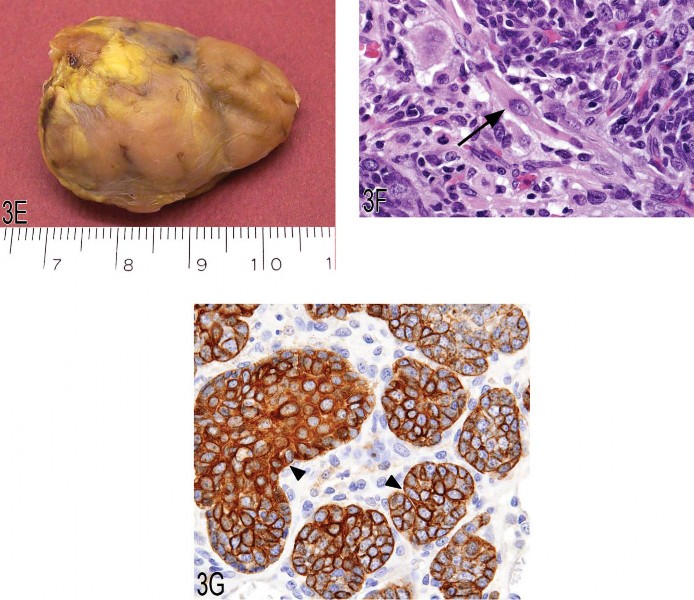 Fig 3. (A, B) Low and high magnifications of a histiocytic sarcoma located in the brain of a B6C3F1 mouse. (C, D) Low and high magnification of a urethral transitional cell carcinoma arising from the proximal urethra (arrow) and invading into adjacent tissues, including the secondary sex glands (arrowheads). Hematoxylin and eosin (C) and uroplakin III immunohistochemistry (D). (E–G) Gross image of a thymoma (E) from the anterior mediastinum of a 1.5-year-old female F344 rat and high magnification illustrating the presence of an occasional large myoid cell (arrow) with abundant eosinophilic and granular cytoplasm and striations. Immunohisto-chemically, epithelial nests are strongly positive for cytokeratin (arrowheads), consistent with epithelial components of a thymoma.