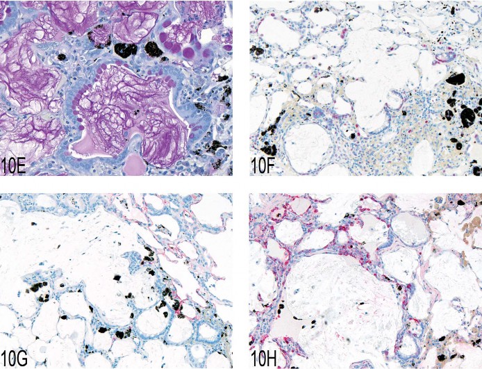 Fig 10. (A–D) Pulmonary mucous cell metaplasia in rat lung after intratracheal instillation of diesel engine exhaust. Hematoxylin and eosin. (E) Periodic acid Schiff–positive material within the lesions of exaggerated mucous cell metaplasia. (F) Immunohistochemistry using anti-PCNA and chromogen Fast Red showing proliferating epithelial and inflammatory cells and black pigment from diesel engine exhaust. (G) Immunohistochemistry using anti-CD54 (ICAM-1) and chromogen Fast Red with positive staining of alveolar type I and type II cells in the lung tissue adjacent to the lesion. (H) Immunohistochemistry using anti-Clara cell secretory protein and chromogen Fast Red illustrating the location and number of Clara cells within the treated lung. 