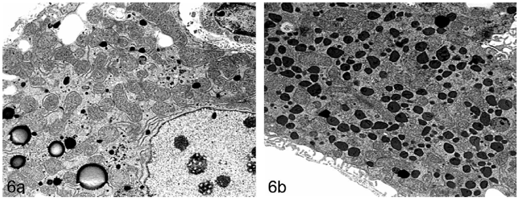FIGURE 6.—(a and b) Transmission electron microscope photograph of B6C3F1 mouse liver showing control (left panel, 6a) and treated (right panel, 6b) hepatocytes characterized by centrilobular hypertrophy and electron dense membrane bound granules in hepatocytes after treatment with a peroxisome proliferator agent (di-isononyl phthalate, DINP).