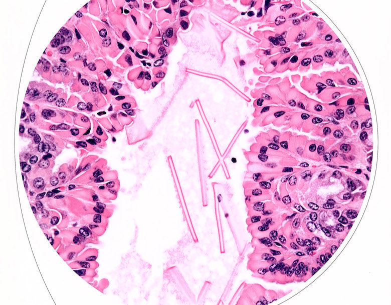Basophilic viral inclusion body in the nucleus of a hepatocyte of one