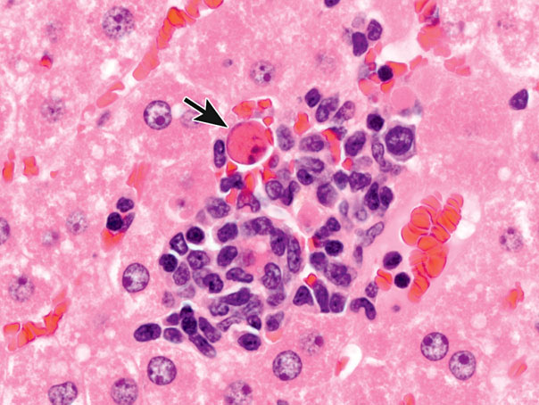 Figure 12. Focus of inflammation in the liver with an apoptotic cell (arrow), considered a “bystander effect.” The apoptotic cell did not rupture and incite the inflammatory response. Rather, the inflammatory cells created an adverse environment for this adjacent hepatocyte.