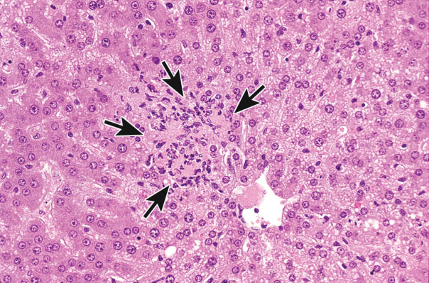 Figure 13. Focus of focal necrosis and inflammation in the liver (arrows) characterized by a focal group of contiguous cells with cell swelling, loss of cellular detail, neutrophils, and cell debris. Previously published in Toxicologic Pathology; Elmore et al. (2014).