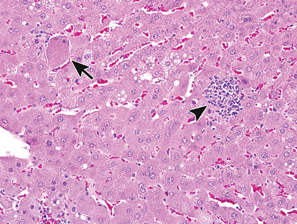 Figure 14. Example of single cell necrosis in the liver. There is marked cell swelling and karyorrhexis in a necrotic hepatocyte (arrow) and a nearby small focus of inflammation (arrowhead), most likely secondary to cell rupture. Previously published in Toxicologic Pathology; Elmore et al. (2014).