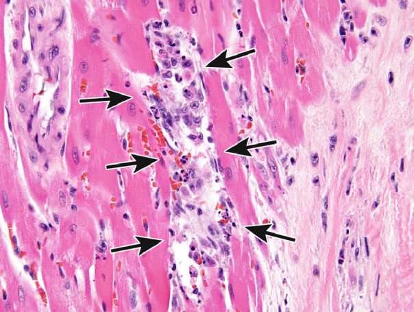 Figure 15. Example of a toxic insult that resulted in apoptosis and necrosis in the heart. Focus of apoptotic and necrotic cardiomyocytes and macrophages in a 14-week-old rat treated with ephedrine and caffeine (Howden et al. 2005; Nyska et al. 2005). This lesion could be diagnosed as apoptosis/single cell necrosis.