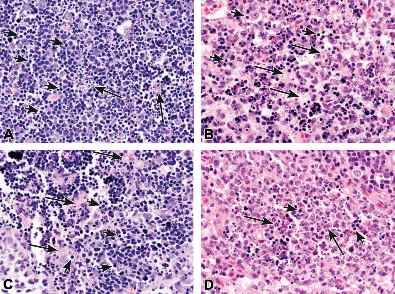 Figure 16. Thymus lymphocyte apoptosis with classic necrosis in a male 3-month-old Sprague-Dawley rat dosed with 1 mg/kg dexamethasone and necropsied 24 to 48 hr later. Over time, this lesion progressed from a strictly apoptotic phenotype to a mostly necrotic phenotype. In (A), the necrotic cell debris is identified as scattered eosinophilic material (cytoplasmic remnants; long arrows) admixed with very small basophilic debris (nuclear remnants). The apoptotic bodies are identified as small, round, densely basophilic structures (A, short arrows). More severe lymphocyte apoptosis and classic necrosis are illustrated in (B). The abundant pale eosinophilic material is evidence of necrosis (B; long arrows) while the small, round, darkly basophilic structures are apoptotic bodies (B; short arrows). Necrotic nuclear debris is also present. (C) is another example of marked lymphocyte apoptosis (short arrows) and classic necrosis (long arrows). Lymphocyte apoptosis and necrosis with inflammation is illustrated in (D). Because classic necrosis is the predominant lesion, this could be diagnosed as necrosis with discussion of apoptotic (D; short arrows) and inflammatory cells (D; long arrows) in the pathology narrative.