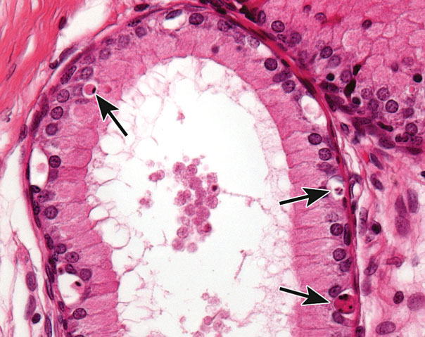Figure 8. Epithelial apoptosis (arrows) in the initial segment of the rat epididymis with luminal cell debris. This is commonly seen in response to reduced testosterone levels because the epididymis is an androgen-dependent tissue. Similar changes can be seen in the seminal vesicles and prostate.